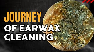 JOURNEY Of Earwax Cleaning [upl. by Ena]