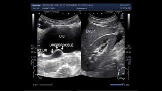 Unilateral Ureterocele [upl. by Ravel395]