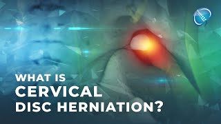 What is Cervical Disc Herniation  Herniated Disc [upl. by Efioa]