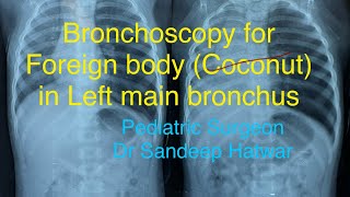 Left bronchial foreign body [upl. by Hsetim487]