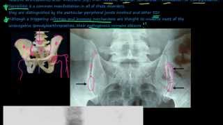 96P Introduction to the Seronegative Spondyloarthropathies [upl. by Ellekram]