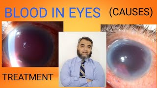 HYPHEMABLOOD ACCUMULATION IN EYES [upl. by Otrebcire]