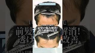 【植毛解説】前髪薄毛が気になる方必見！生え際植毛で変わる前髪透け感 植毛 [upl. by Nolaf]