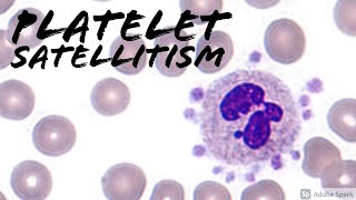 Platelet SatellitismSatellitosis from EDTA amp Pseudothrombocytopenia Hemepath amp Hematology [upl. by Waly]