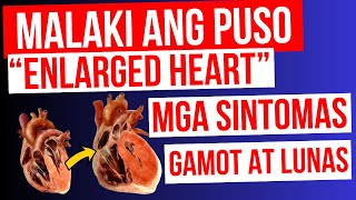 ENLARGED HEART  Lumalaki ang PUSO  Mga Sintomas Gamot at LUNAS  Cardiomegaly Heart Failure [upl. by Monie194]