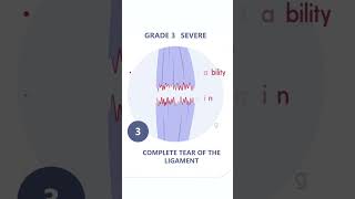 Ligament Injuries Simplified Grades of Severity and Their Impact sportsscience physiotherapy [upl. by Enninaej977]
