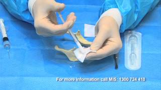 Bone Grafting simplified with BondBone by MIS [upl. by Kcoj]