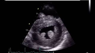 Make the Diagnosis  interesting ECHO Case [upl. by Dory]