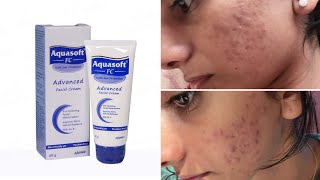 Aquasoft fc Advanced facial cream Review Malayalam  Indian pharmacy product for acne prone skin [upl. by Ahsikyw]