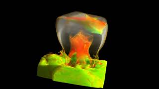 Ultrasound Detection of Cracks in Teeth [upl. by Iramat]