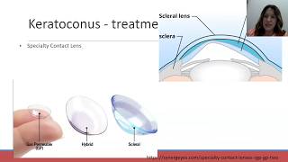 Lecture Optometry to the Extreme How We Manage Our Extreme Cases [upl. by Duile]