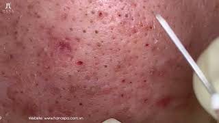 Big Cystic Acne Blackheads Extraction Blackheads amp Milia Whiteheads Removal Pimple Popping [upl. by Micco204]