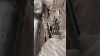 Dissection of Cubital fossa and its contents [upl. by Murage]