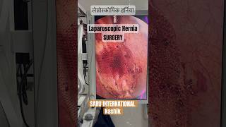 Hernia surgery Laparoscopic Hernia Surgery in Nashik Hernia hernia [upl. by Adivad]