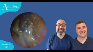 CRUSTY HARD EAR INFECTION REMOVAL  EP788 [upl. by Acilgna]