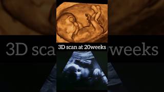 3D scan at 20 weeks of pregnancy [upl. by Hokanson]