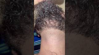 Ingrown hairs satisfying ingrownhairremoval barber removingingrown hair hairproblem [upl. by Deny]