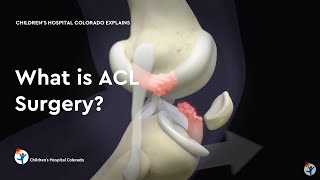 What is ACL Surgery [upl. by Aitercal897]