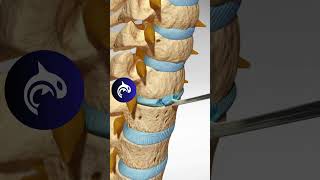 See how an Artificial Cervical Disc Replacement of the Spine works in 3D animation [upl. by Liw]