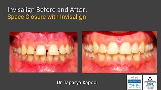 Invisalign Before and After Spacing correction [upl. by Biron639]