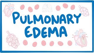 Pulmonary Edema  causes symptoms diagnosis treatment pathology [upl. by Niwrud470]