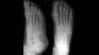 5th Metatarsal Base fractures Jones fracture [upl. by Anawot]