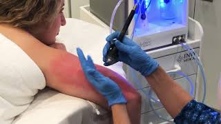 Dermalinfusion for KP Keratosis Pilaris [upl. by Shyamal444]