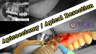 APICOECTOMY  Apical Resection  Root Canal Surgery [upl. by Aeirdna812]