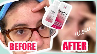 Nizoral Shampoo how to use Mechanism of action Uses Dosage Side Effects [upl. by Gnos]