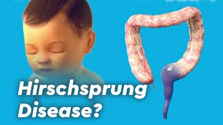 Hirschsprung Disease Colitis and Fecal Incontinence [upl. by Eileen311]