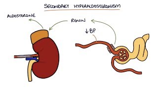 Hyperaldosteronism and Conns Syndrome [upl. by Hayarahs]