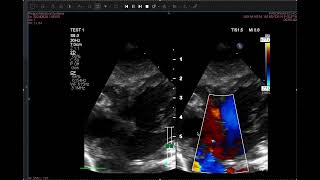 D transposition with tricuspid valve atresia ASD and VSD [upl. by Siravrat338]