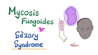 Mycosis Fungoides and Sèzary Syndrome  Hematology amp Oncology [upl. by Aneet]