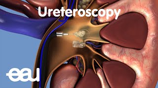 Removal of kidney stones URS [upl. by Gurevich]