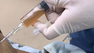 Como Hacer Una PARACENTESIS Abdominal  Prácticas De Enfermería  enfermeria viralvideo [upl. by Joline609]