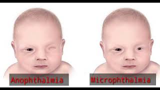 what is Anophthalmia  Microphthalmia  Terms means  Optometry solution [upl. by Akinorev413]