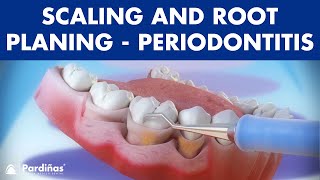 Treatment of periodontal disease  Scaling and root planing  Tartar © [upl. by Eli]