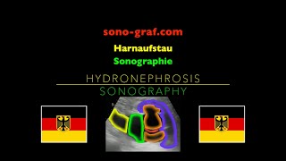 Sonographie  Harnaufstau [upl. by Nolyarg]