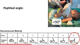 Gestational Age Estimation in Newborn  Newborn Examination Part4  Pediatrics [upl. by Alda]