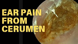 CATASTROPHIC Ear Pain From Impacted Cerumen [upl. by Christalle]