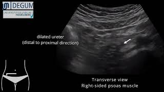 Episode 37 NephroUrolithiasis [upl. by Oxford183]