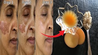 Pigmentation treatment on face  pigmentation treatment at home  simple home remedies [upl. by Assyli845]