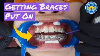 Process of Getting Braces [upl. by Meares]