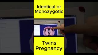 Identical or Monozygotic Twins Pregnancy  Judwa Bachy shorts shortvideo [upl. by Zurek]