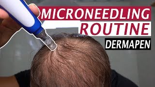 My Microneedling Routine and Derma Rolling for Hair Loss [upl. by Sebastian]