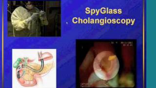 Management of difficult bile duct stones with the Holmium laser through SpyGlass [upl. by Ytnom]