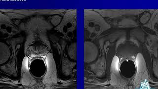 06 Risonanza Magnetica della prostata stato dell’arte e prospettive future Antonio DellOsso [upl. by Legnaros]