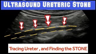 URETERIC CALCULUS  Ultrasound Tracing And Finding URETERIC STONE [upl. by Eahcim]