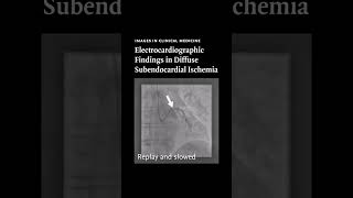 Images in Clinical Medicine Electrocardiographic Findings in Diffuse Subendocardial Ischemia [upl. by Weitman]