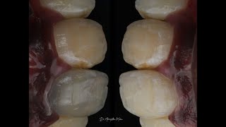 MANAGING AN EXTREMELY DISCOLOURED TOOTH WITHOUT BLEACHING OR ANY RESTORATION [upl. by Rramaj]